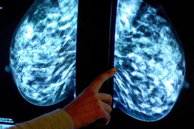 Generic stock picture of a mammogram showing a womans breast in order check for breast cancer at Derby City Hospital.